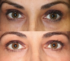 Dr. John Burroughs, Colorado Springs Ophthalmic Plastic Surgeon, Shares A Lower Eyelid Result