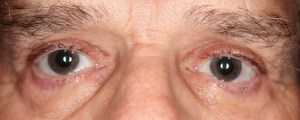 Dr. John Burroughs, Colorado Springs Ophthalmic Plastic Surgeon, Shares A Blepharoplasty Result