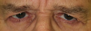Dr. John Burroughs, Colorado Springs Ophthalmic Plastic Surgeon, Shares A Blepharoplasty Result.