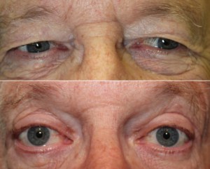 Before and After Pictures of An Upper Blepharoplasty & Brow Lift by Dr. John Burroughs, Colorado Springs Eyelid Surgeon.