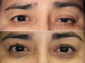 Can A Droopy Eyelid Be Fixed Without A Scar? Dr. John Burroughs, Colorado Springs Eyelid Surgeon, Answers.
