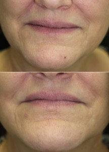 What can be done for the folds “parentheses lines” around the mouth? Dr. John Burroughs, Colorado Springs Oculofacial Plastic Surgeon, Answers?
