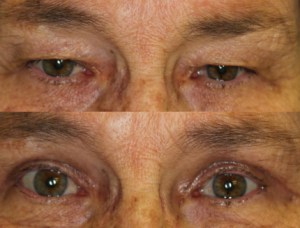 What will my eyes look like after eyelid surgery? Dr. John Burroughs, Colorado Springs Facial Plastic Surgeon, Answers.