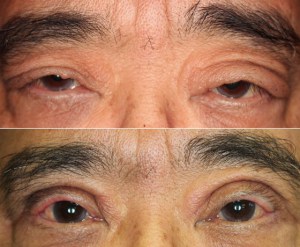 Before & After Result of Patient With Severe Upper Eyelid Swelling & Upper Eyelid Entropion By Dr. John Burroughs, Colorado Springs Plastic Surgeon.