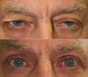 What can be done for droopy eyelids? What is the surgery like? Dr. John Burroughs, Colorado Springs Plastic Surgeon, Answers.