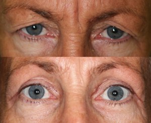 Dr. John Burroughs, Colorado Plastic Eyelid Surgeon, Shares Before & After Upper Blepharoplasty (Eyelid Lift).