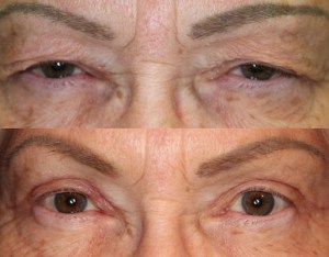 Dr. John Burroughs, Colorado Springs Plastic Surgeon, Shares A Before & After Eyelid Lift.