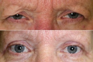 Blepharoplasty after surgery? Dr. John Burroughs, Colorado Springs Plastic Eye Surgeon, shares a result.