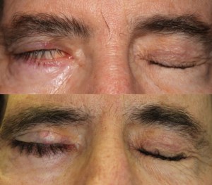 Dr. John Burroughs, Colorado Springs Plastic Eyelid Surgeon, Discusses Paralyzed Eyelids.