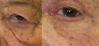 What can be done for upper cheek and lower eyelid bags? Dr. John Burroughs answers.