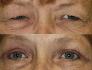 Eyelid Incisions Stay Red, Raised, or Firm?