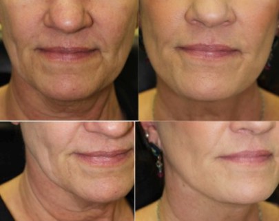 Natural Appearing Facelift by Dr. John Burroughs, Colorado Springs, CO.