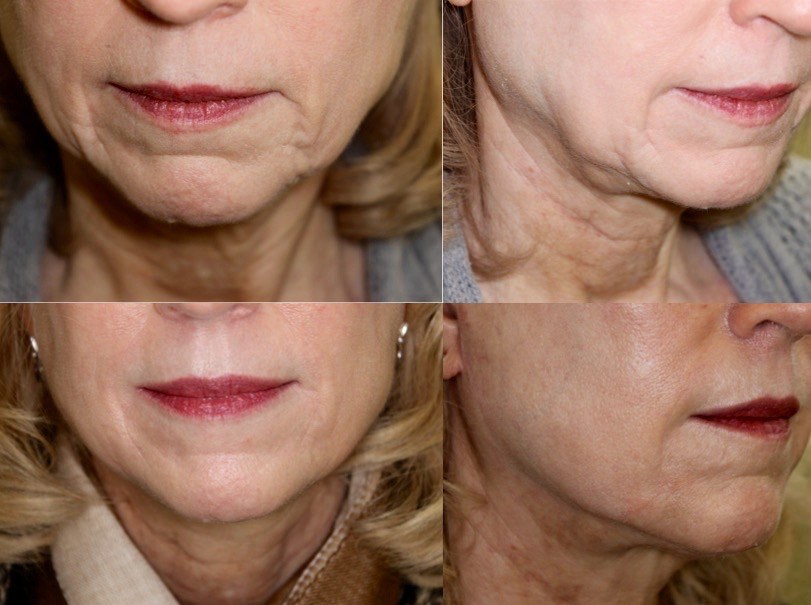 Mini-Incision Facelift. What can it do? Dr. John Burroughs, Colorado Springs Cosmetic Surgeon, Answers.