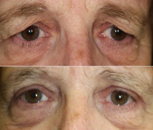 What Is An Upper Eyelid Blepharoplasty? Dr. John Burroughs, Colorado Springs Plastic Eyelid Surgeon, Answers.