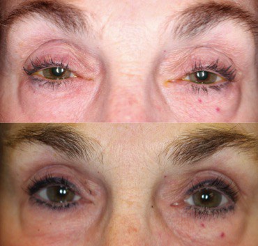 Why Do My Eyelids Droop? What Is Ptosis? Dr. John Burroughs Answers.