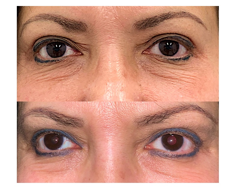 Improving Eyelid Wrinkles: Laser for the Eyelids By Dr. John Burroughs