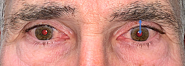 Aged Male Brow: Lifting the Forehead Without Effeminizing
