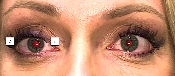 Beyond Wrinkles: Advanced Botulinum Injections around the Eyes to Improve Surgery