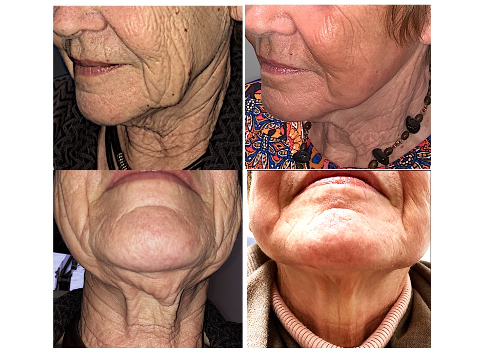 Face and Neck Lift in Colorado Springs, CO