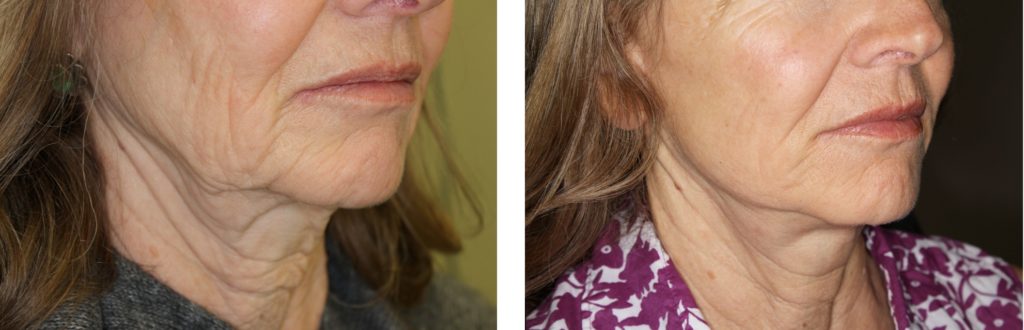 Facelift/Mini-Incision Facelift Before and After Pictures Colorado Springs, CO