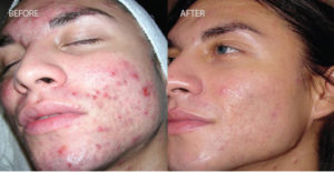 Dermalinfusion Before and After Pictures Colorado Springs, CO
