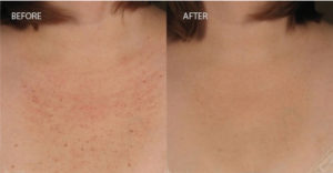 Dermalinfusion Before and After Pictures Colorado Springs, CO