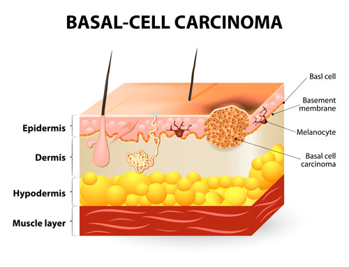 Skin Cancer Removal & Reconstruction in Colorado Springs, CO