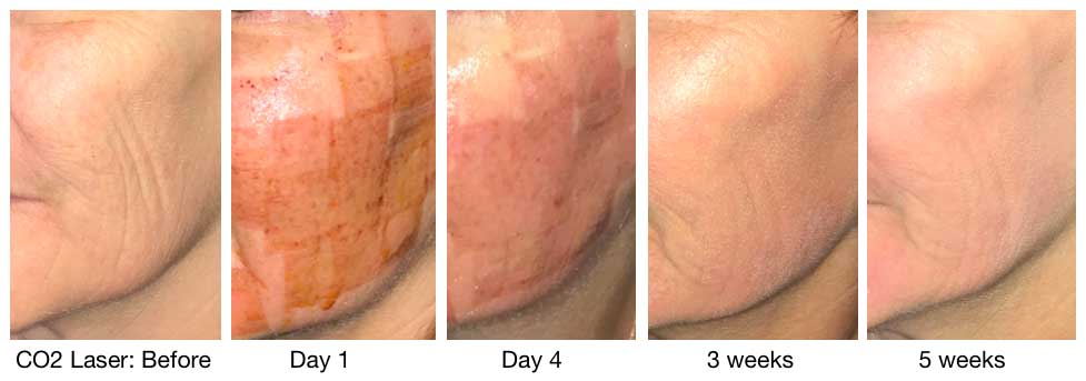 Fractora/Morpheus Skin Resurfacing Before and After Pictures Colorado Springs, CO
