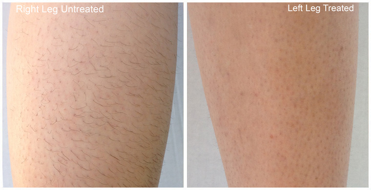 Laser Hair Removal Before and After Pictures Colorado Springs, CO