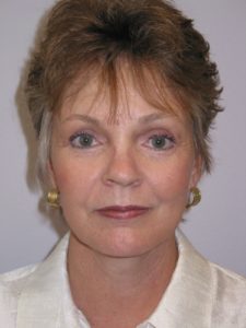 Facelift/Mini-Incision Facelift Before and After Pictures Colorado Springs, CO