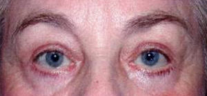 Blepharoplasty Before and After Pictures Colorado Springs, CO