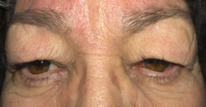Blepharoplasty Before and After Pictures Colorado Springs, CO