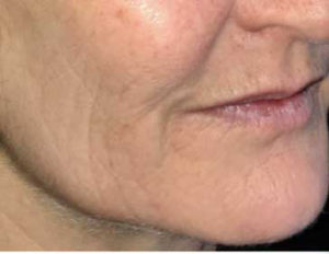 CO2 Laser Skin Resurfacing Before and After Pictures in Colorado Springs, CO
