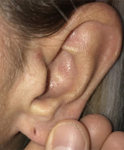 Earlobe Repair Before and After Pictures in Colorado Springs, CO