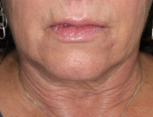 Facelift/Mini-Incision Facelift Before and After Pictures in Colorado Springs, CO