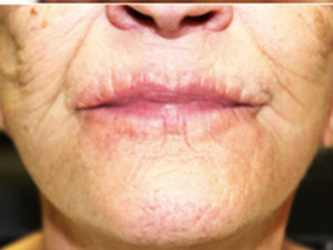 Facelift/Mini-Incision Facelift Before and After Pictures in Colorado Springs, CO