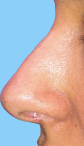 Dermal Fillers and Injectables Before and After Pictures in Colorado Springs, CO