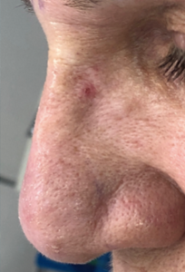 Dermal Fillers and Injectables Before and After Pictures in Colorado Springs, CO