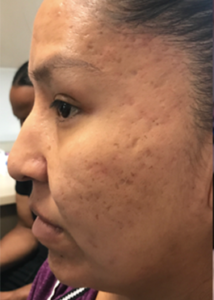 Fractora/Morpheus Skin Resurfacing Before and After Pictures in Colorado Springs, CO
