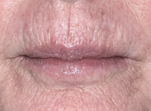 Fractora/Morpheus Skin Resurfacing Before and After Pictures in Colorado Springs, CO