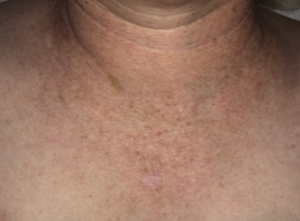 IPL Photofacial Before and After Pictures in Colorado Springs, CO