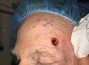 Skin Cancer Removal Before and After Pictures in Colorado Springs, CO
