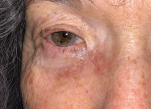 Skin Cancer Removal Before and After Pictures in Colorado Springs, CO