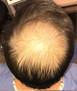 PRP Hair Restoration Before and After Pictures in Colorado Springs, CO