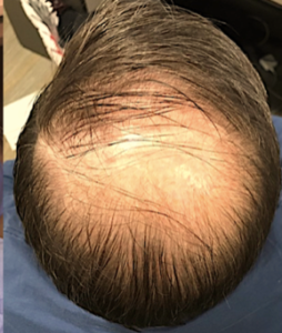 PRP Hair Restoration Before and After Pictures in Colorado Springs, CO