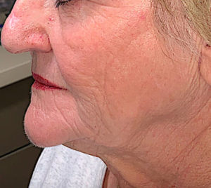 CO2 Laser Skin Resurfacing Before and After Pictures in Colorado Springs, CO