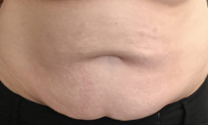 BodyFX Before and After Pictures in Colorado Springs, CO