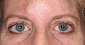 Brow Lift Before and After Pictures in Colorado Springs, CO