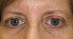 Brow Lift Before and After Pictures in Colorado Springs, CO