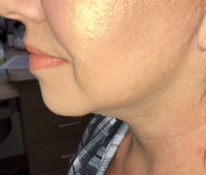 Facetite and Necktite Before and After Pictures in Colorado Springs, CO